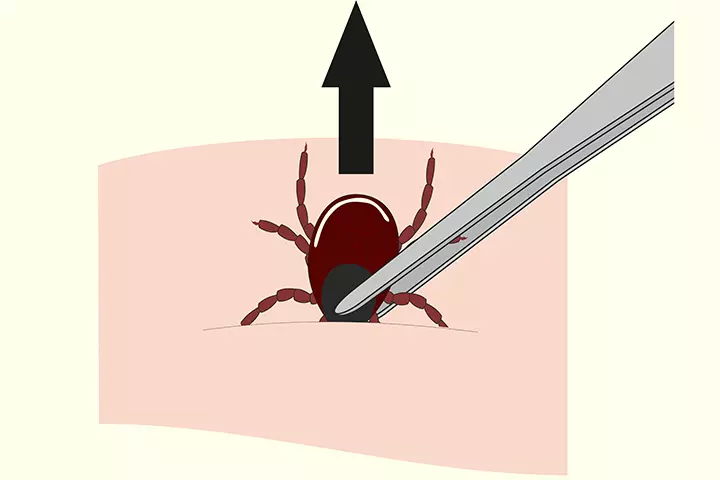 How To Remove A Tick