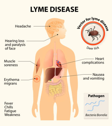 Lyme Disease In Children: Causes, Symptoms And Treatment_image