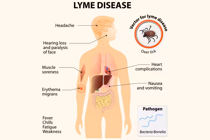 Lyme Disease In Children Lyme Disease In Children