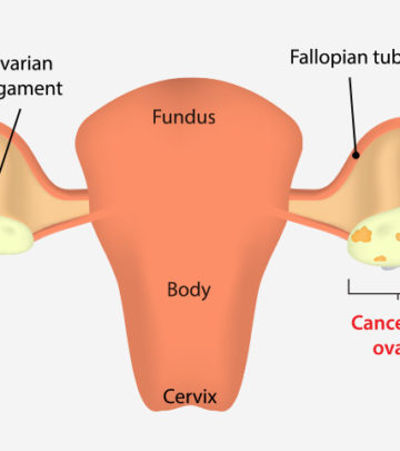 Ovarian Cancer During Pregnancy - Everything You Need To Know