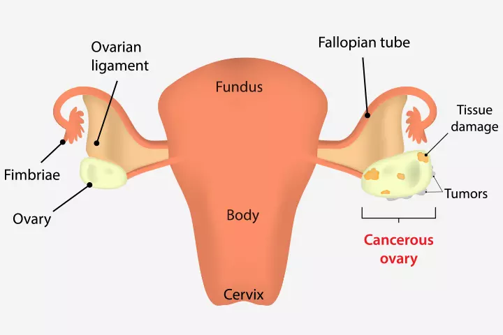 Ovarian Cancer During Pregnancy – Everything You Need To Know_image