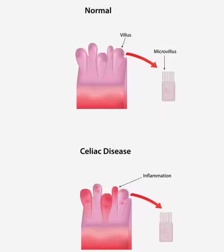 Celiac Disease During Pregnancy - Causes, Symptoms, Diagnosis & Treatments