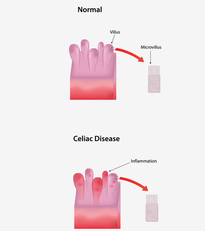 Celiac Disease During Pregnancy - Causes, Symptoms, Diagnosis & Treatments