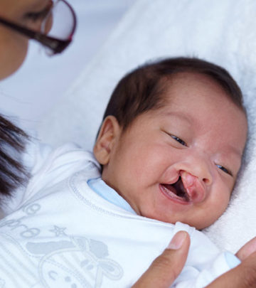 Cleft Lip In Babies – Causes, Symptoms & Treatments