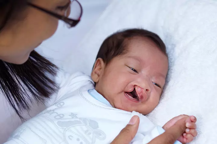 Cleft Lip In Babies – Causes, Symptoms & Treatments_image