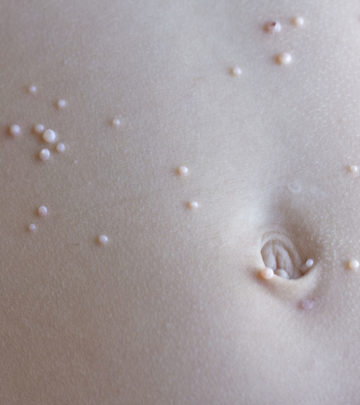 Molluscum-Contagiosum-In-Babies