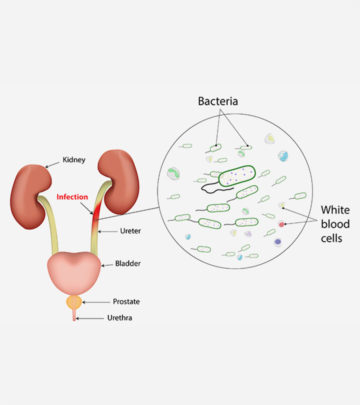 Urinary Tract Infection During Pregnancy