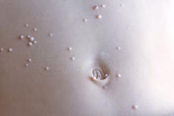Molluscum Contagiosum In Babies Molluscum Contagiosum In Babies