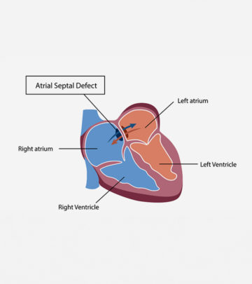 Atrial Septal Defect In Children – Symptoms And Treatment