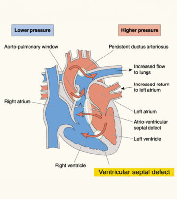 Ventricular Septal Defect In Children – All You Need To Know