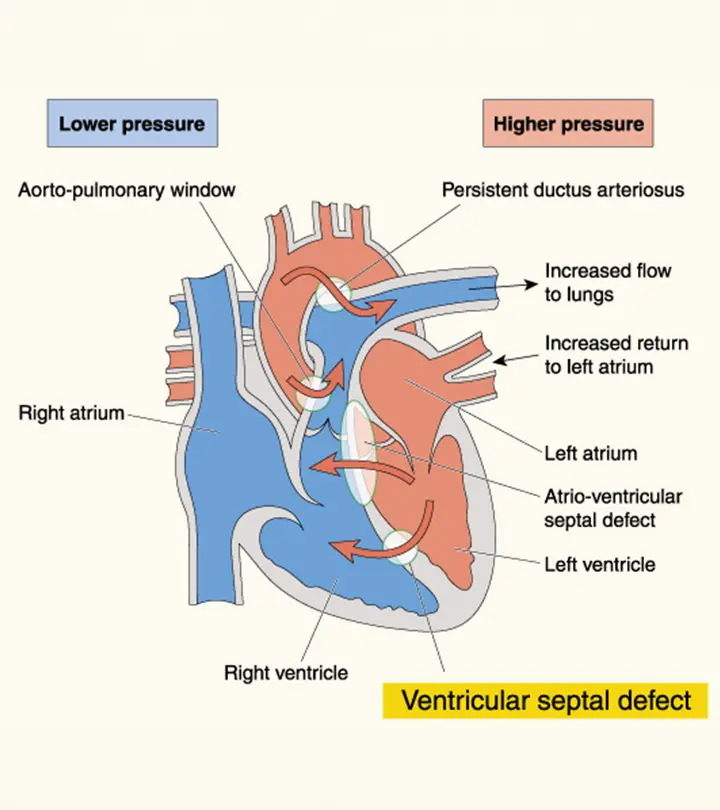 Ventricular Septal Defect In Children – All You Need To Know