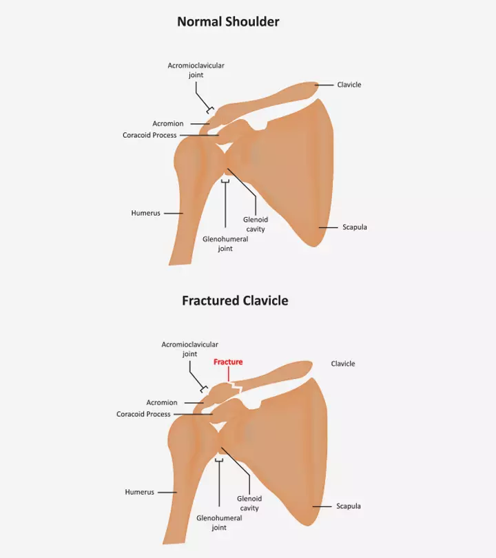 Broken Collarbone In Children: Symptoms, Diagnosis & Treatment_image