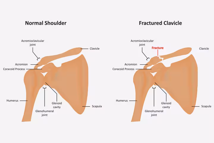 Broken Collarbone In Children Broken Collarbone In Children