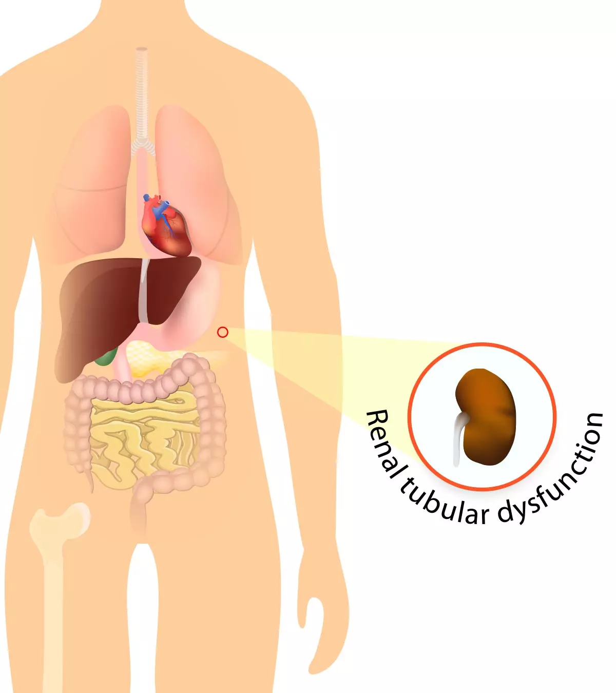 Renal Tubular Acidosis In Children – Symptoms & Treatment_image