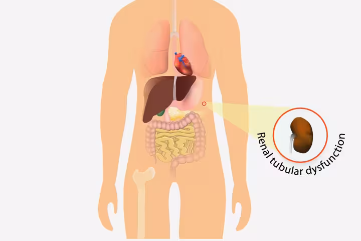 Renal Tubular Acidosis In Children Renal Tubular Acidosis In Children