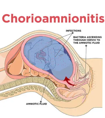 Chorioamnionitis: What Is It And How Is It Treated_image