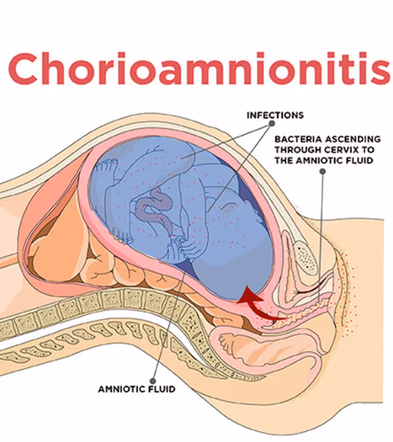 Chorioamnionitis2