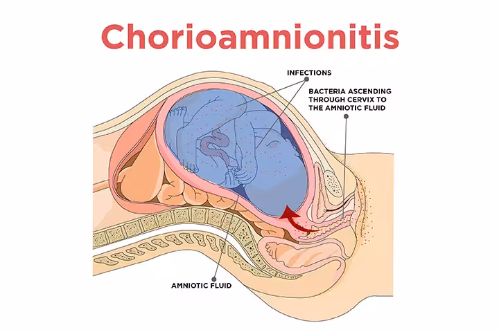Intra amniotic Infection IntrIntra amniotic Infectiona-amniotic-Infection