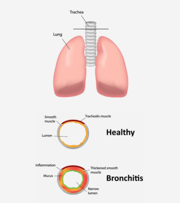 Bronchitis In Children: Symptoms, Causes And Treatment_image