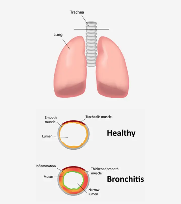 Bronchitis In Children1