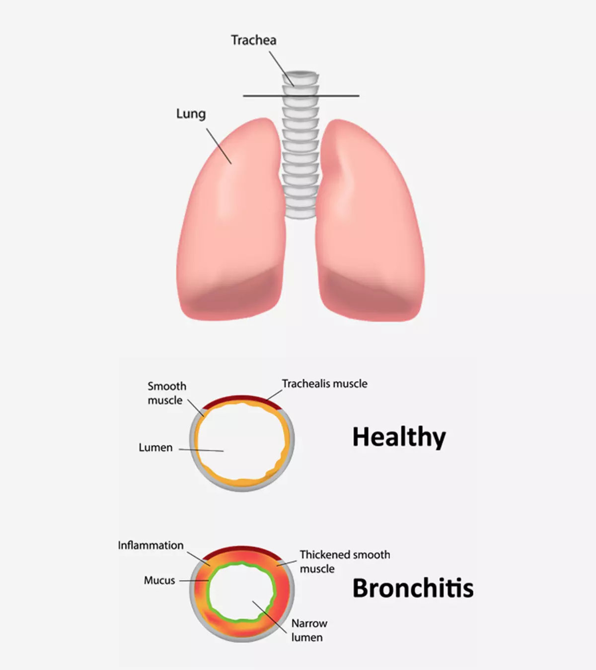 Bronchitis In Children: Symptoms, Causes And Treatment_image