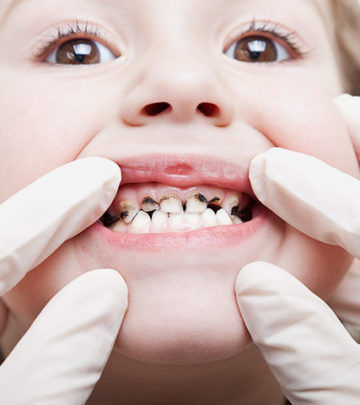 Cavities In Children - Causes, Symptoms, Remedies & Solutions