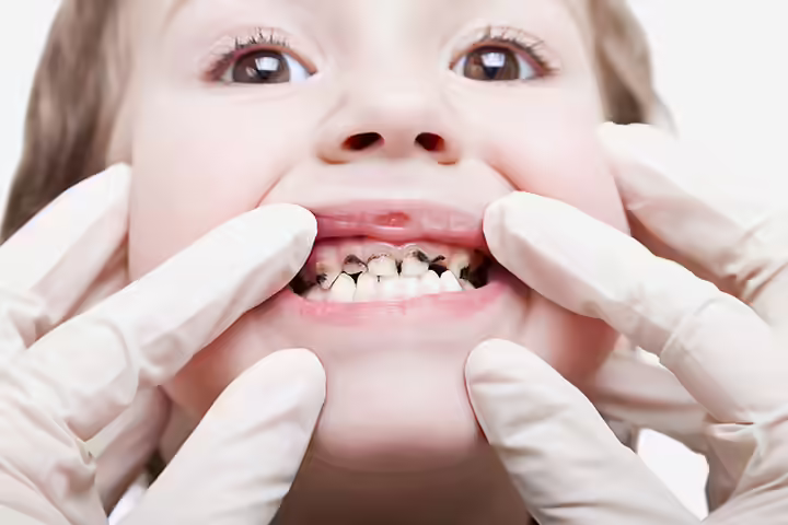 Cavities In Children Cavities In Children