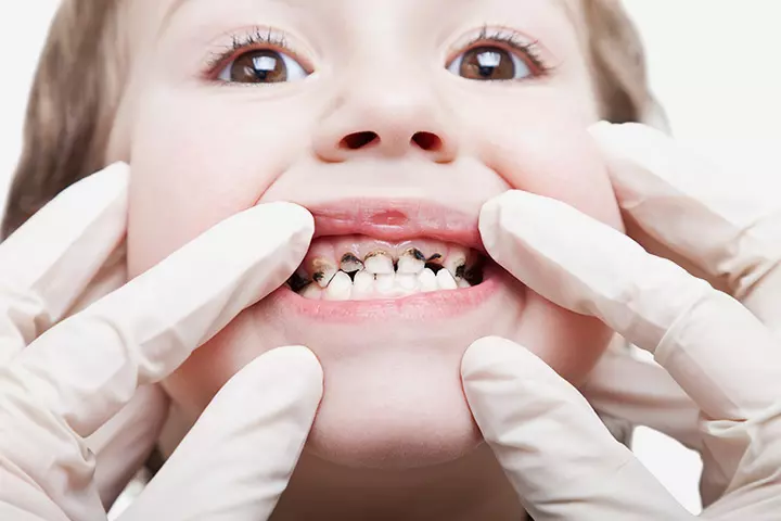 Cavities In Children – Causes, Symptoms, Remedies & Solutions