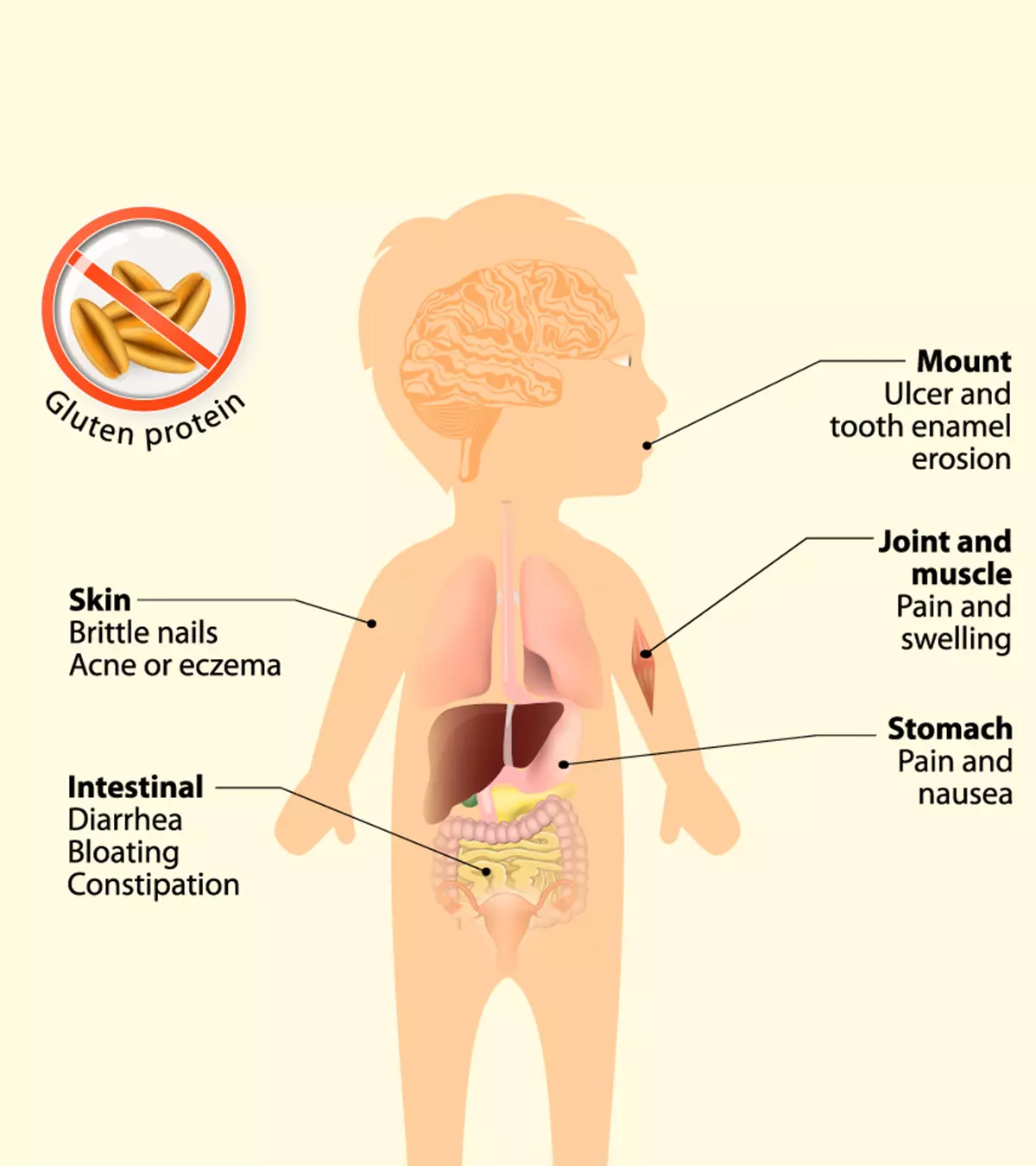 Celiac Disease In Children – Causes, Symptoms & Treatment_image