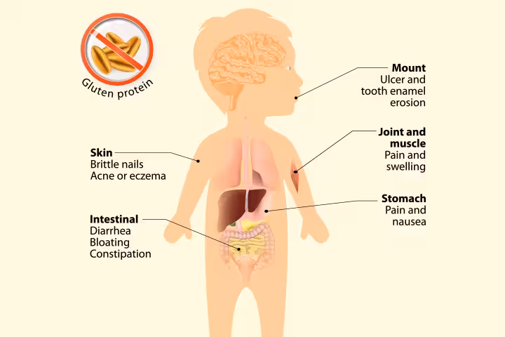 Celiac Disease In Children Celiac Disease In Children