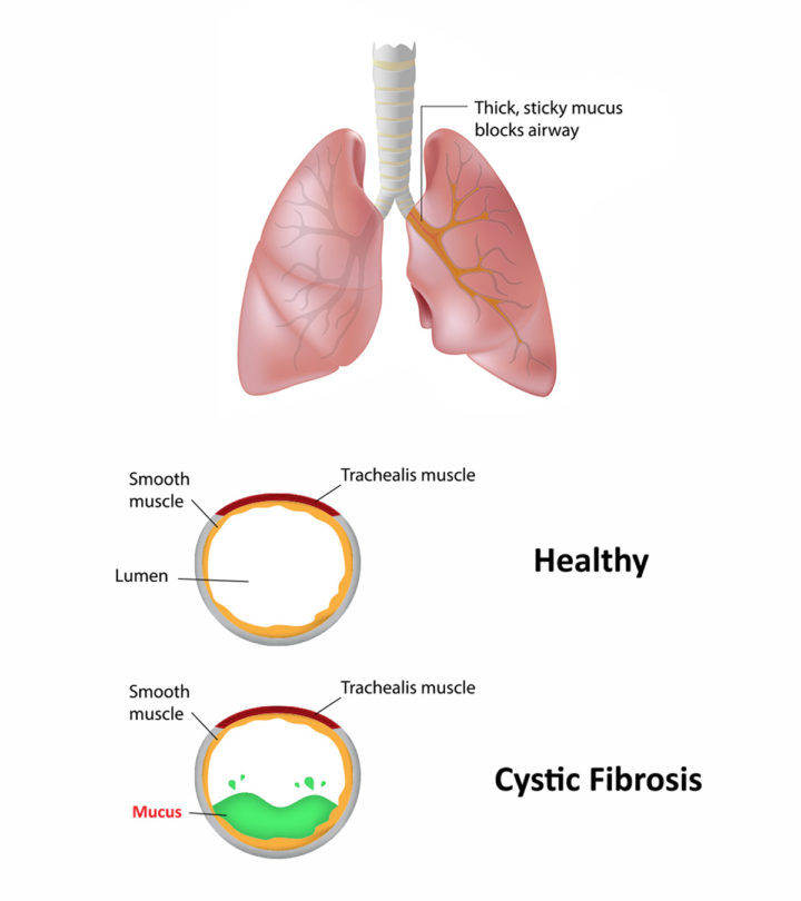 Cystic-Fibrosis-In-Children---Causes,-Symptoms-&-Treatment