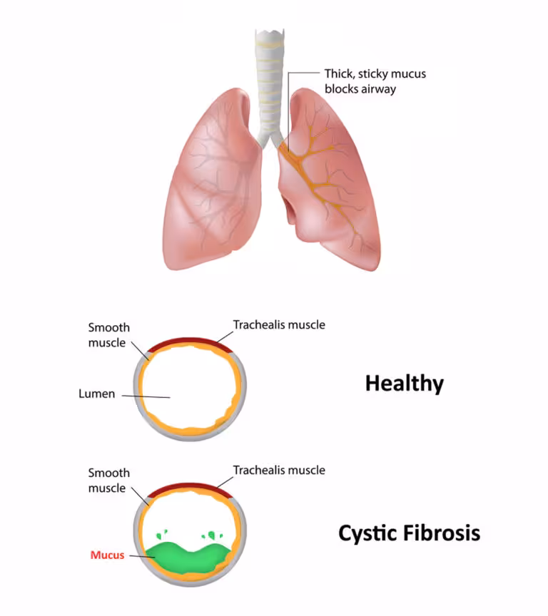 Cystic-Fibrosis-In-Children---Causes,-Symptoms-&-Treatment