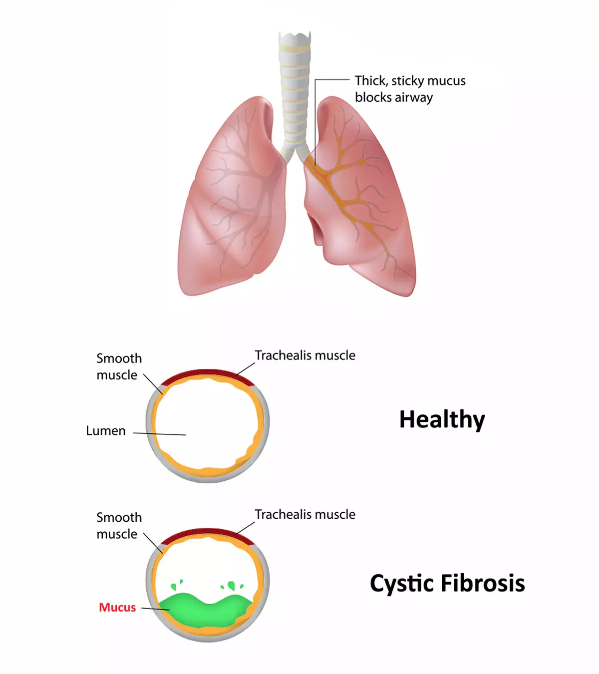 Cystic Fibrosis In Children – Causes, Symptoms & Treatment_image