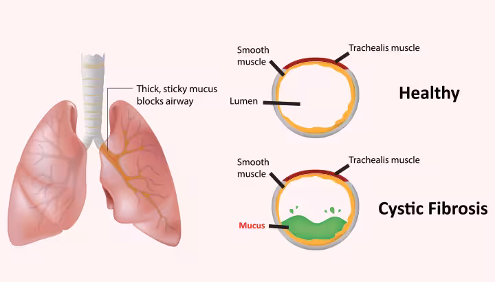 Cystic Fibrosis In Children