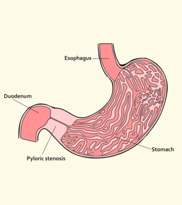 Pyloric Stenosis: Causes, Symptoms And Treatment_image