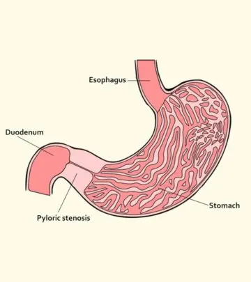 Pyloric Stenosis: Causes, Symptoms And Treatment_image