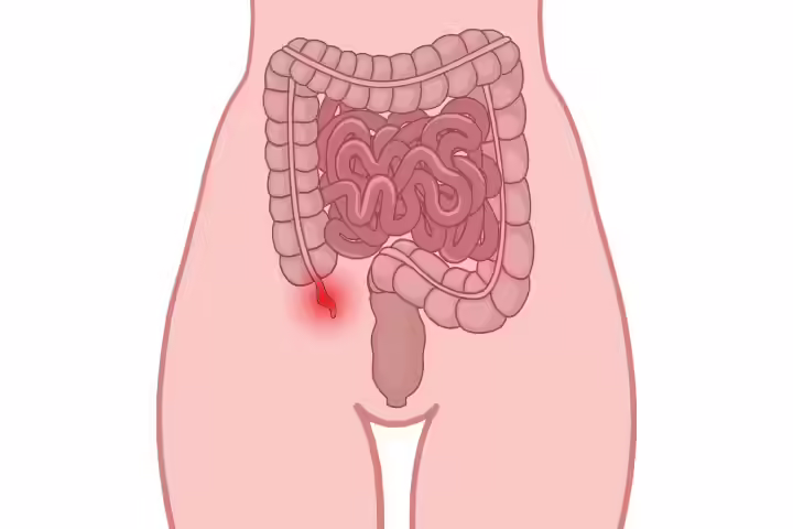 What Is Appendicitis What Is Appendicitis