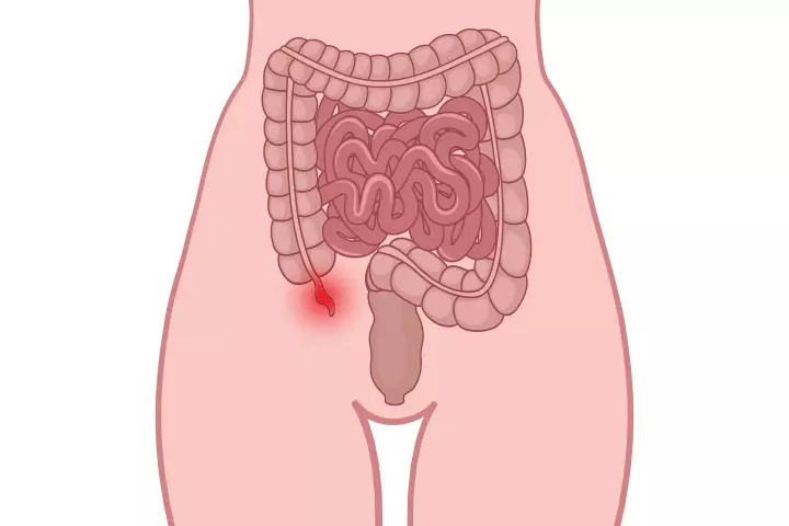 What Is Appendicitis