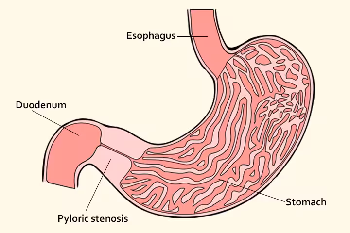 Pyloric Stenosis In Babies Pyloric Stenosis In Babies