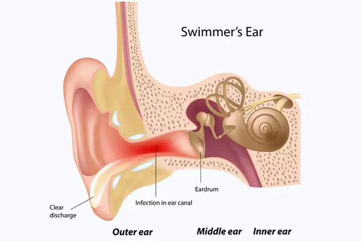 Acute otitis externa (AOE)