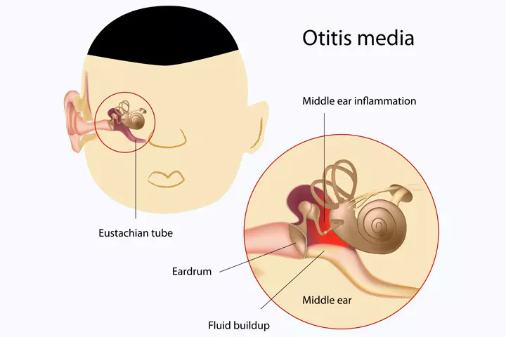 Middle ear infections or otitis media (OM)