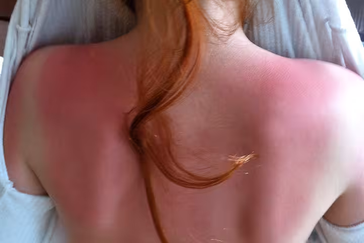 Skin Cancer In Children Skin Cancer In Children