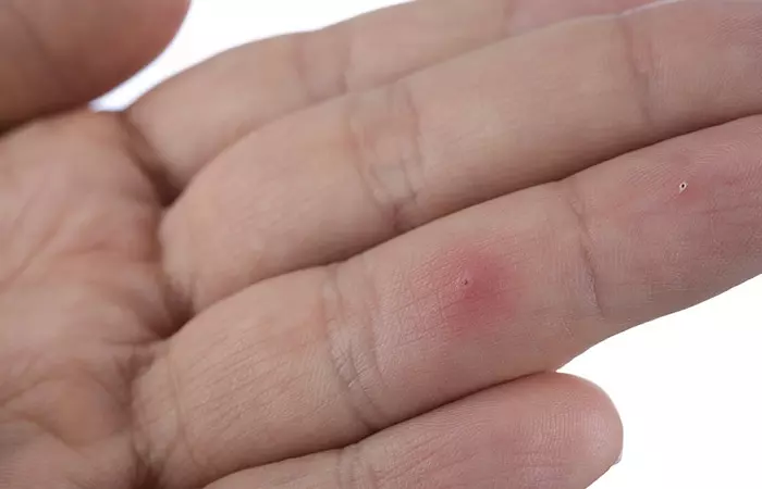 Remove That Irritating Splinter Without Any Pain