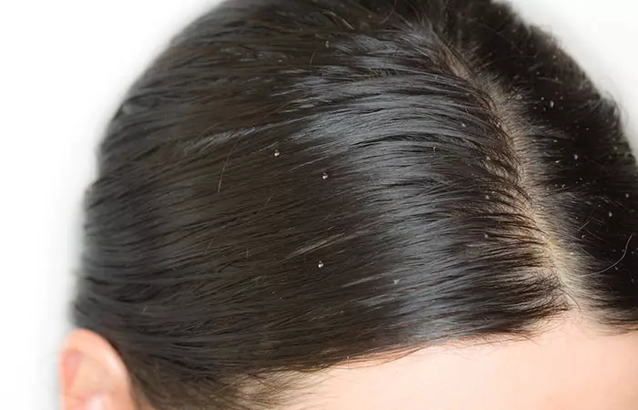 It-Helps-You-Get-Rid-Of-Oily-Hair-And-Oily-Scalp.