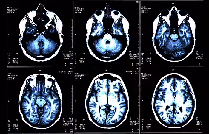 Multiple Sclerosis