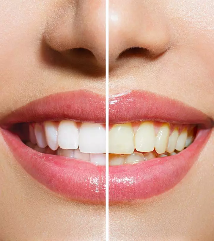 What Is The Best Way To Whiten Your Teeth?_image