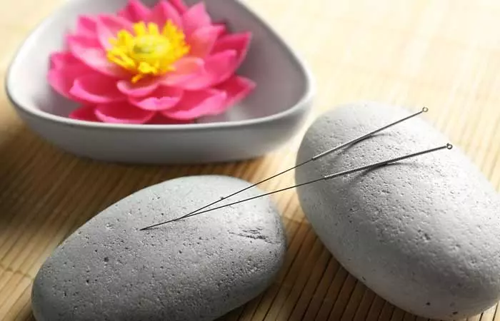 7. Acupuncture And Acupressure