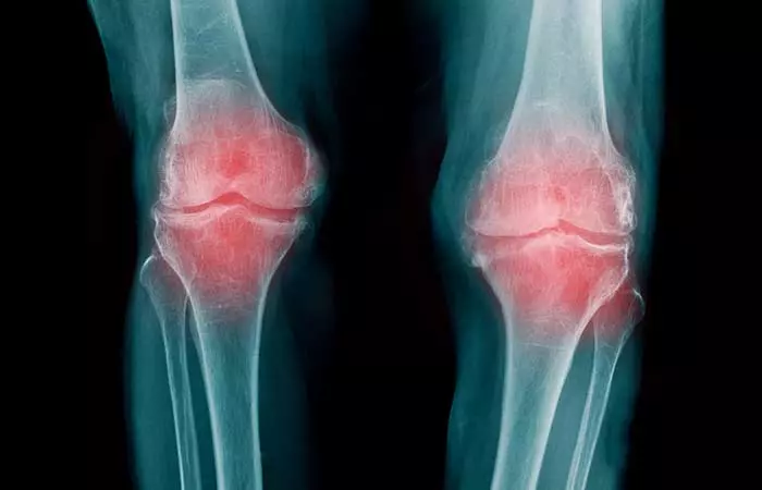 Wait, I Know What Osteoarthritis Is… Sort Of. But Still, Go Ahead And Refresh My Memory!