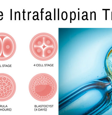 Infertility Treatment – Zygote Intrafallopian Transfer (ZIFT)