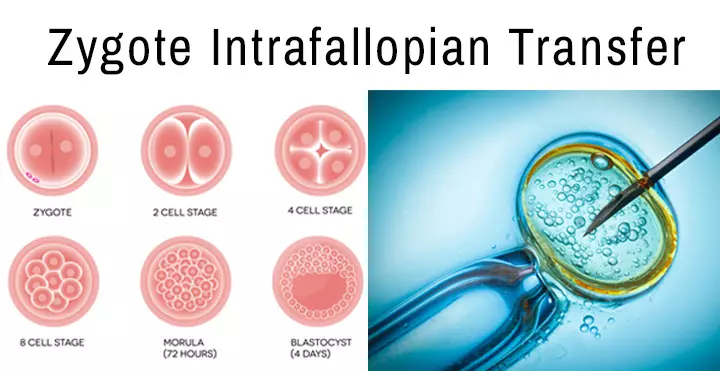 Infertility Treatment – Zygote Intrafallopian Transfer (ZIFT)_image